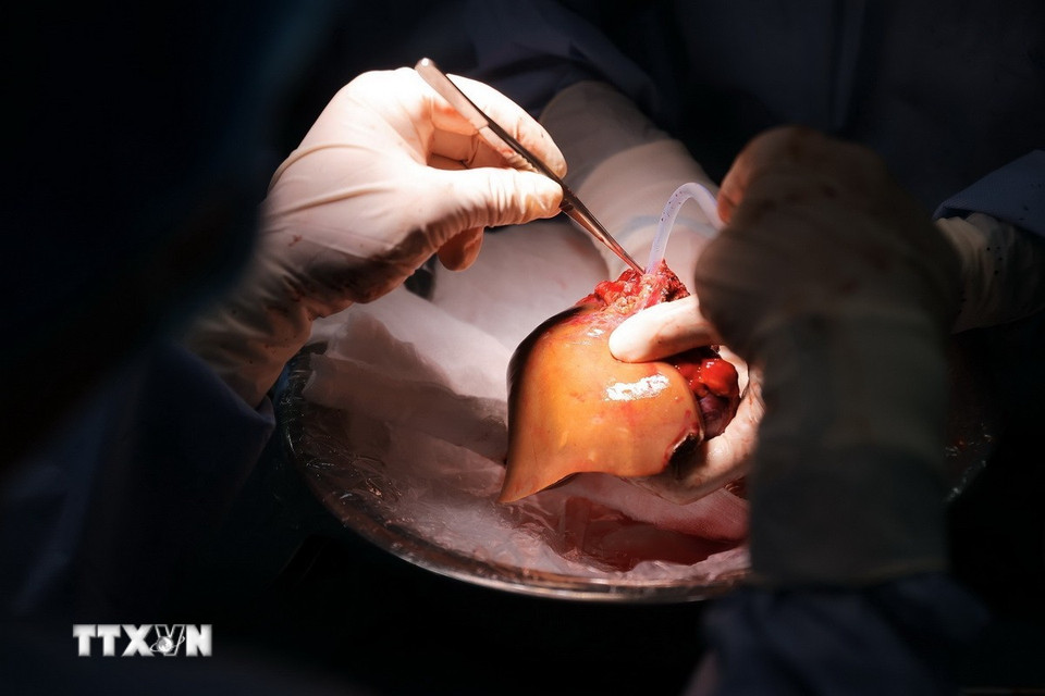Gan được lấy từ người hiến chuẩn bị hiến cho bệnh nhi. (Ảnh: Minh Quyết/TTXVN)
