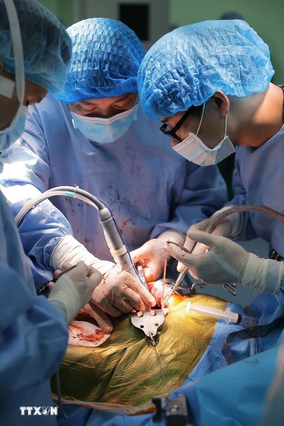 Êkíp phẫu thuật lấy một phần gan của người hiến. (Ảnh: Minh Quyết/TTXVN)