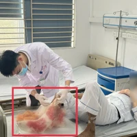 Bệnh nhân nhập viện trong tình trạng cẳng chân hoại tử nặng, bốc mùi hôi thối. (Ảnh: PV/Vietnam+)
