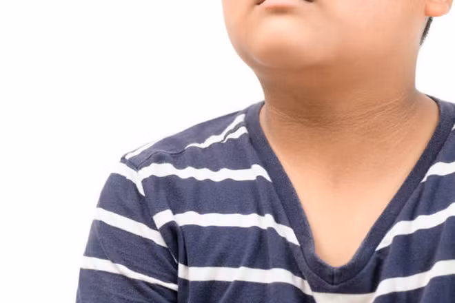 Da cổ dày và sẫm màu là biểu hiện của kháng insulin. (Ảnh: iStock) khang-insulin.jpg