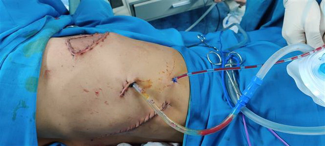 Phẫu thuật thành công trường hợp u thành ngực xâm lấn rộng ảnh 3