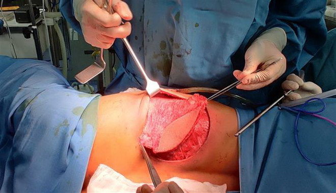 Phẫu thuật thành công trường hợp u thành ngực xâm lấn rộng ảnh 1