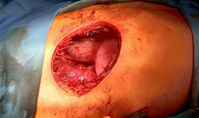 Phẫu thuật thành công trường hợp u thành ngực xâm lấn rộng ảnh 2