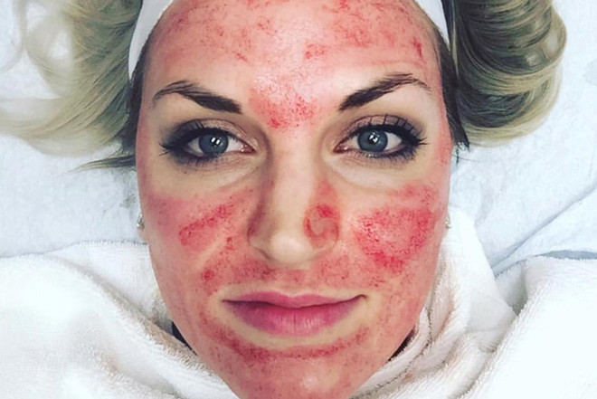 Nguy cơ bị nhiễm HIV với phương pháp làm đẹp “mặt nạ ma cà rồng” ảnh 1