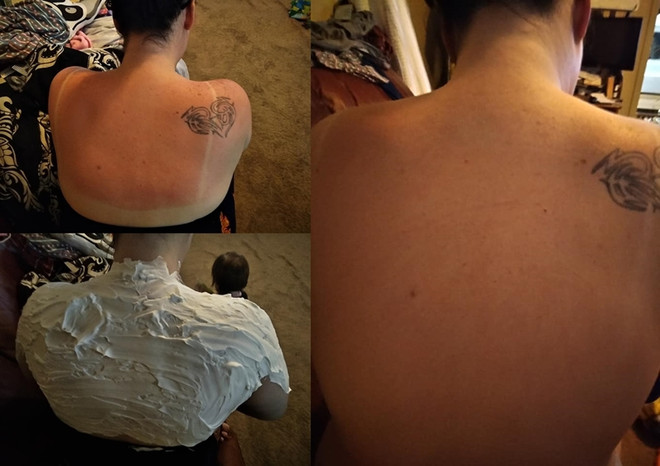 Thực hư về công dụng chữa cháy nắng cấp tốc của bọt cạo râu ảnh 1