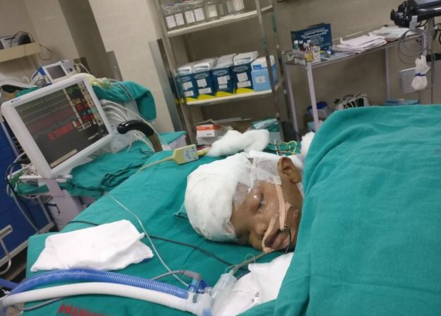 Ấn Độ phẫu thuật tách thành công cặp song sinh dính đầu ảnh 3