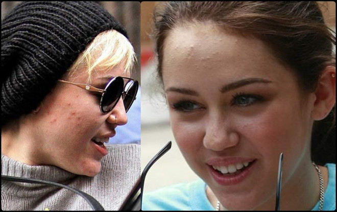 Không chỉ riêng bạn, các ngôi sao cũng từng khổ sở vì làn da ảnh 9