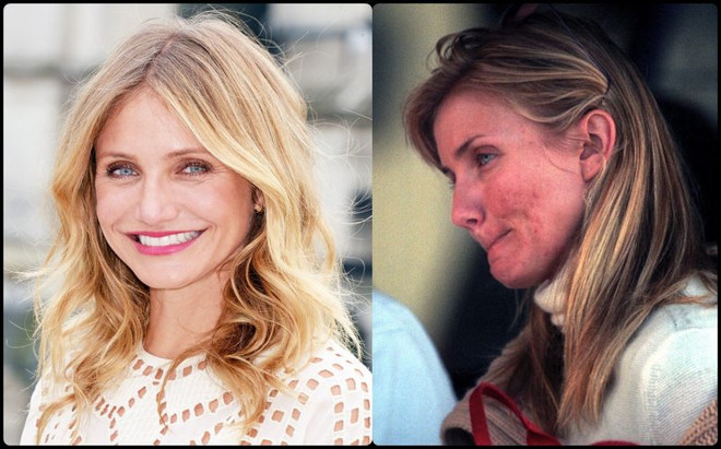 Không chỉ riêng bạn, các ngôi sao cũng từng khổ sở vì làn da ảnh 5