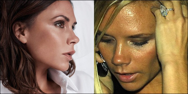 Không chỉ riêng bạn, các ngôi sao cũng từng khổ sở vì làn da ảnh 7