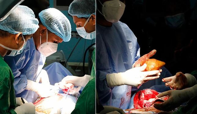 Sri Lanka: Phẫu thuật loại bỏ viên sỏi thận lớn nhất thế giới ảnh 1