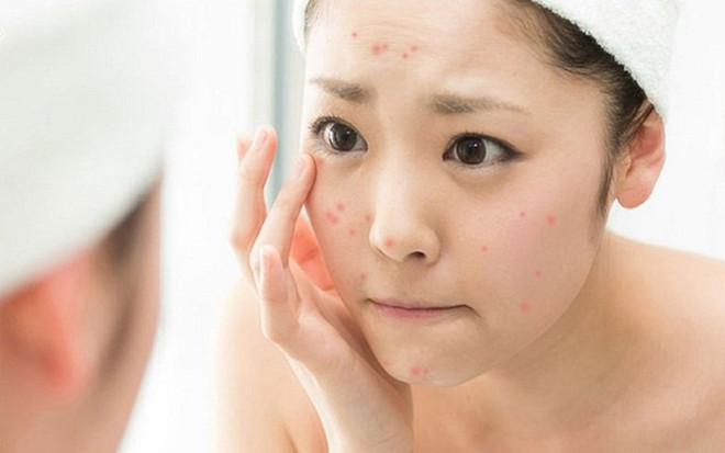 9 điều bạn không thể bỏ qua nếu muốn trị mụn thành công ảnh 1