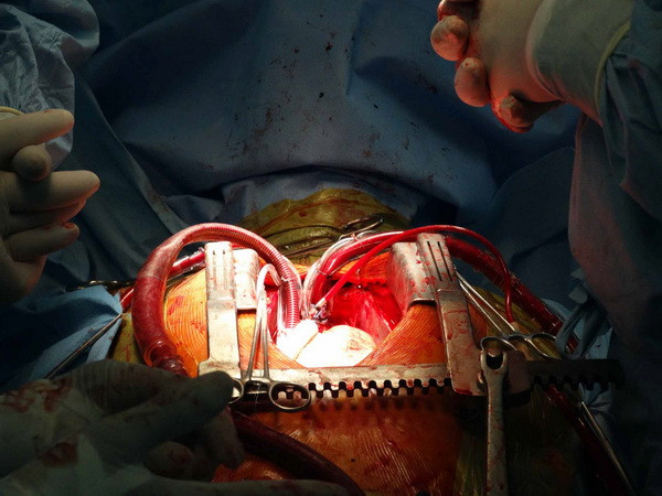 [Photo] Thực hiện ca cấy tim nhân tạo bán phần đầu tiên ở Việt Nam ảnh 1