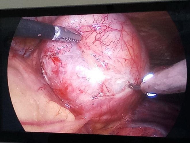 Đà Nẵng: Phẫu thuật thành công cho bệnh nhân có khối u trung thất lớn ảnh 2