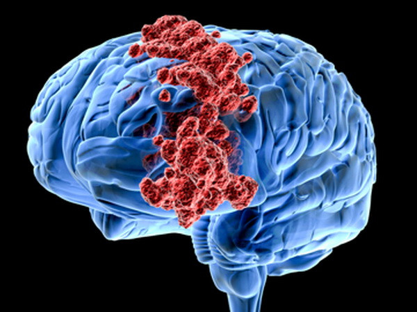 Dùng tia laser giúp bệnh nhân ung thư não sống lâu hơn so với hóa trị ảnh 1