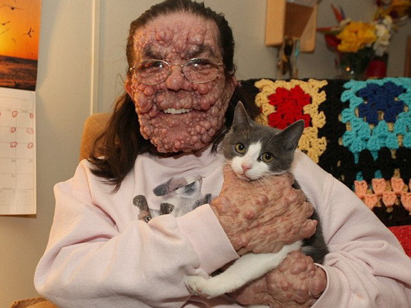 Người phụ nữ bị u bong bóng khác thường vượt lên số phận ảnh 1