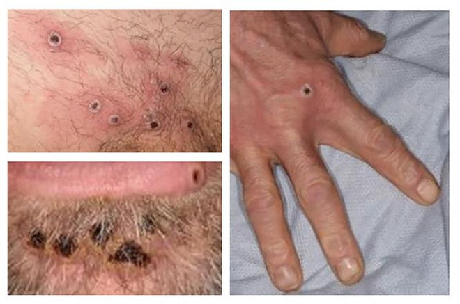 Tổ chức Y tế thế giới công bố thêm 2 ca tử vong do bệnh đậu mùa khỉ ảnh 1