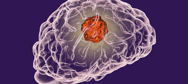 Phát triển phân tử mồi nhử giúp hạn chế di căn ung thư não, vú ảnh 1