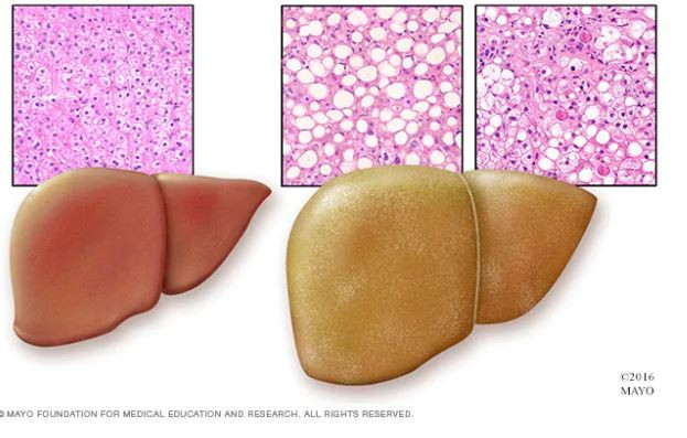 Khả năng phát hiện sớm bệnh gan nhiễm mỡ không do rượu ảnh 1