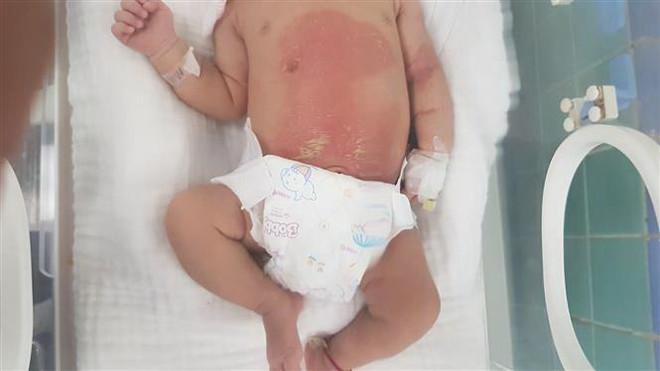 Tự chữa bệnh ở nhà theo kinh nghiệm dân gian, trẻ sơ sinh bị bỏng nặng ảnh 1