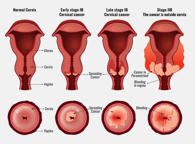 ung thu co tu cung.jpg