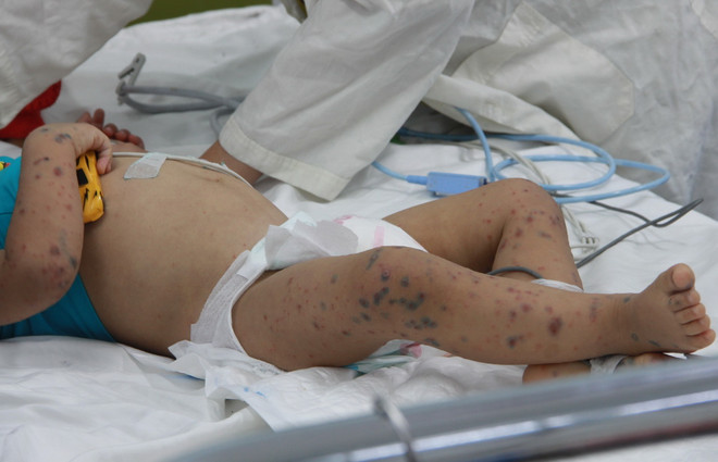 ttxvn-tay chan mieng2.jpg