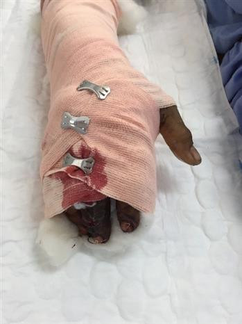 Cứu sống hai bệnh nhân bị biến chứng nguy kịch do rắn độc cắn ảnh 2