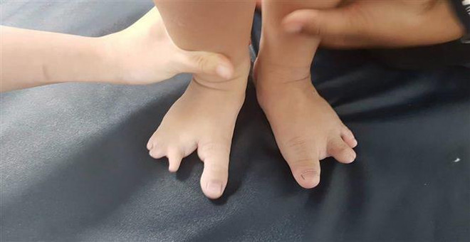 Sửa dị tật bàn tay, bàn chân như hình càng cua cho bệnh nhi 2 tuổi ảnh 1
