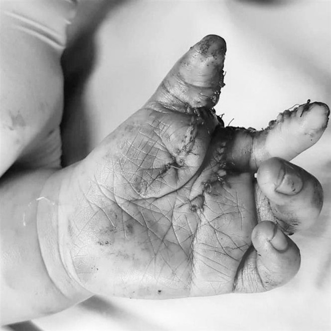 Sửa dị tật bàn tay, bàn chân như hình càng cua cho bệnh nhi 2 tuổi ảnh 3