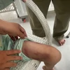 Thương tích trên người bé M.T. (Ảnh: PV/Vietnam+)