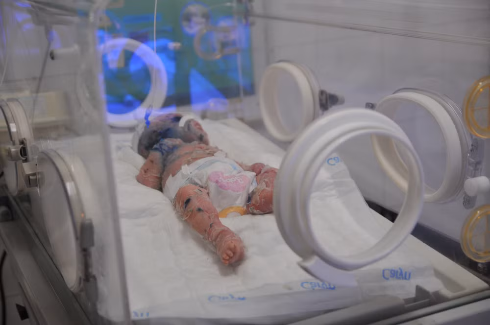 Điều trị cho bé trai 2 tháng tuổi mắc bệnh da vảy cá hiếm gặp ảnh 1