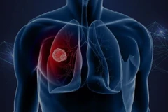 Ảnh minh họa. (Nguồn: WCRF)