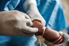 Nhân viên y tế điều trị cho bệnh nhân mắc đậu mùa khỉ tại một quốc gia châu Phi hồi năm ngoái. (Ảnh: THX/TTXVN)