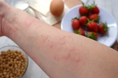 Ảnh minh họa. (Nguồn: Food Allergies Atlanta)
