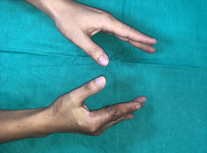 Patientens finger efter mikrokirurgi har återhämtat sig väl. (Foto: PV/Vietnam+) sau-mo-4-tuan.jpg