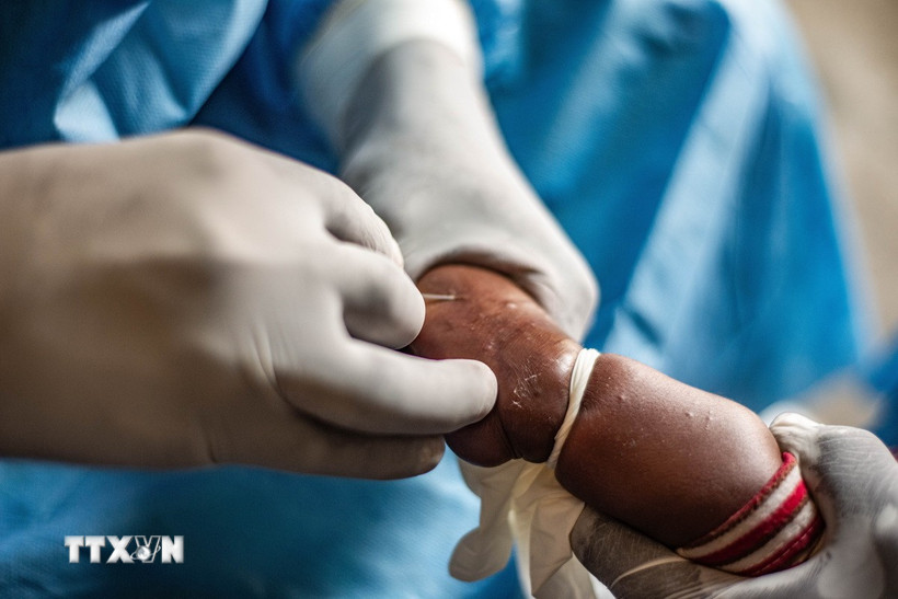 Nhân viên y tế điều trị cho bệnh nhân mắc đậu mùa khỉ tại Goma, CHDC Congo ngày 15/8/2024. (Ảnh: THX/TTXVN)