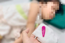 Các bác sỹ lấy ra dị vật là chiếc kẹp tóc bệnh nhân đã nuốt. (Ảnh: PV/Vietnam+)