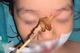 Que xiên thịt nướng cắm sâu từ vùng gốc mũi trái của bệnh nhi. (Ảnh: PV/Vietnam+)