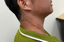 Người bệnh với những dấu vết do giun rồng gây ra. (Ảnh: PV/Vietnam+)