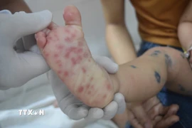 Các nốt phát ban của bệnh nhi bị tay chân miệng. (Ảnh: TTXVN/Vietnam+)