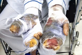 Bà N.T.T. với các vết thương sâu ở tay. (Ảnh: PV/Vietnam+)