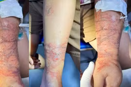 Tổn thương trên cánh tay của bệnh nhi trước khi điều trị. (Ảnh: PV/Vietnam+)