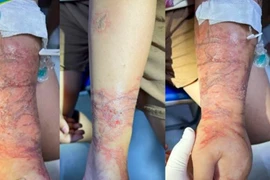 Tổn thương trên cánh tay của bệnh nhi trước khi điều trị. (Ảnh: PV/Vietnam+)