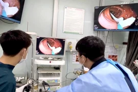Các bác sỹ nội soi gắp con sán trong đại tràng của bệnh nhân. (Ảnh: PV/Vietnam+)