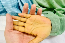 Bàn tay của bệnh nhân khi bị hôn mê gan do suy gan cấp tính, viêm gan virus B. (Ảnh: PV/Vietnam+)