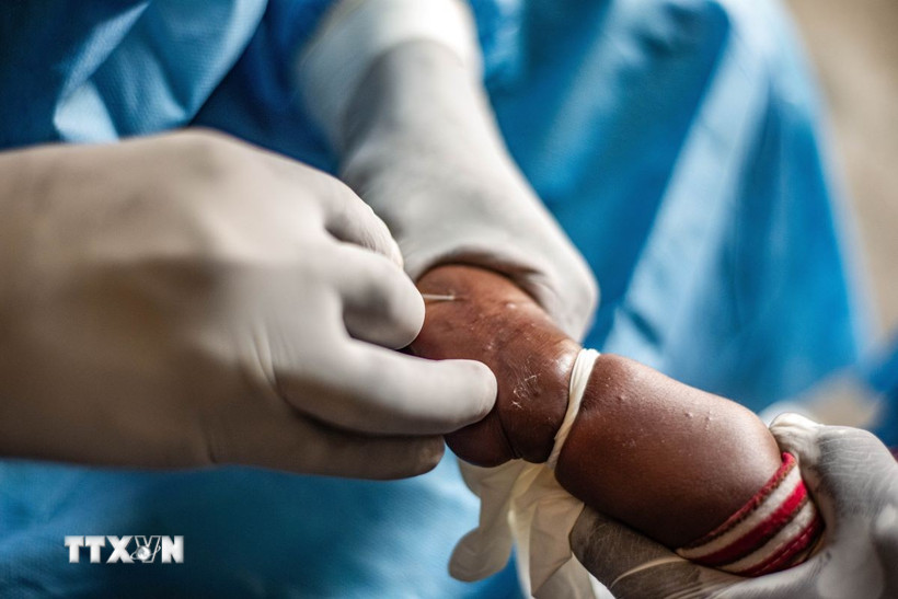 Nhân viên y tế điều trị cho bệnh nhân mắc đậu mùa khỉ. (Ảnh: THX/TTXVN)