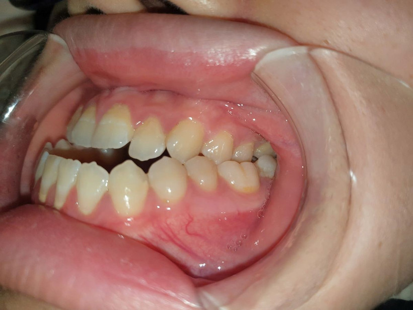 Khớp cắn ngược (răng trên ở sau răng dưới).