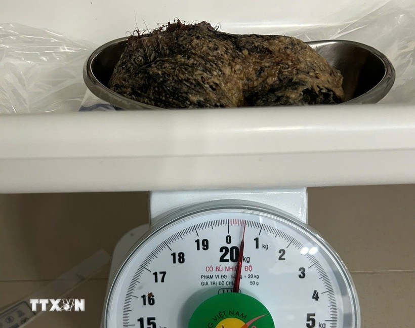 Búi tóc được gắp ra từ dạ dày bệnh nhi. (Ảnh: TTXVN phát)