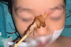 Que xiên thịt nướng cắm sâu từ vùng gốc mũi trái của bệnh nhi. (Ảnh: PV/Vietnam+)