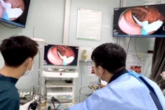 Các bác sỹ nội soi gắp con sán trong đại tràng của bệnh nhân. (Ảnh: PV/Vietnam+)