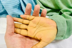 Bàn tay của bệnh nhân khi bị hôn mê gan do suy gan cấp tính, viêm gan virus B. (Ảnh: PV/Vietnam+)